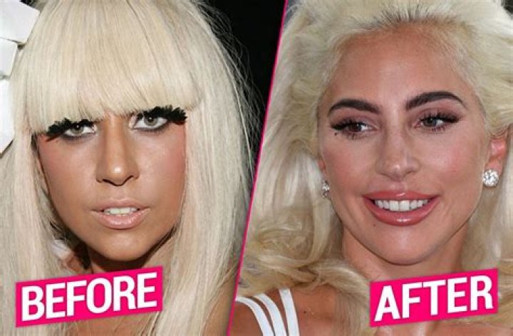Has Lady Gaga Had Plastic Surgery?