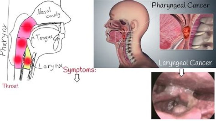 John Berry Has Throat Cancer